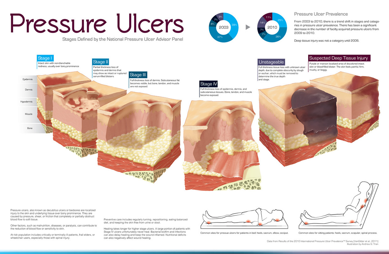 Illustration and infographic for Pressure Ulcers